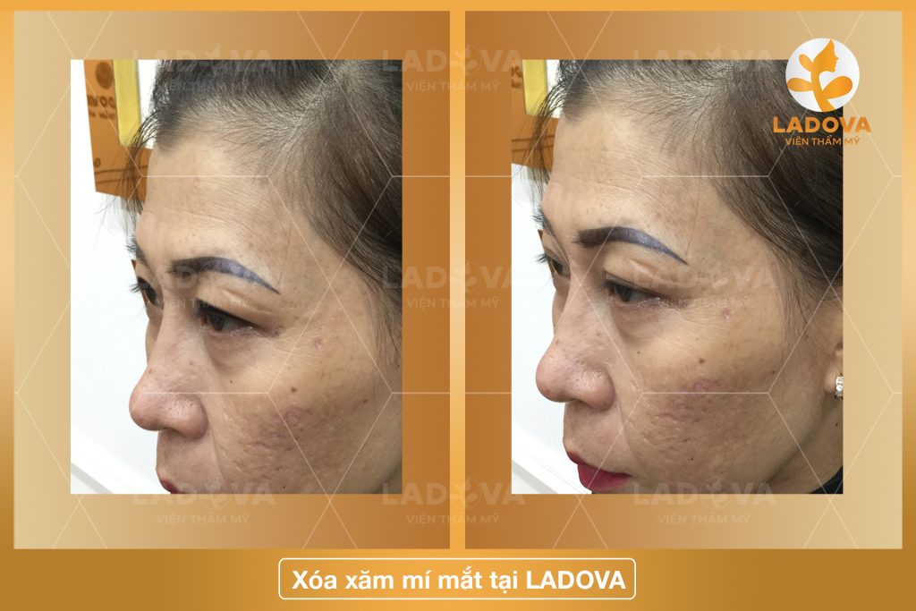 XOA-XAM-MI-MAT