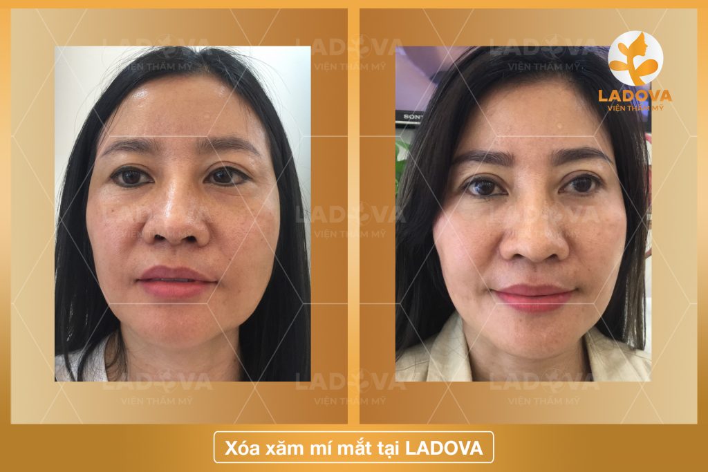 XOA-XAM-MI-MAT-KHONG-DE-LAI-SEO