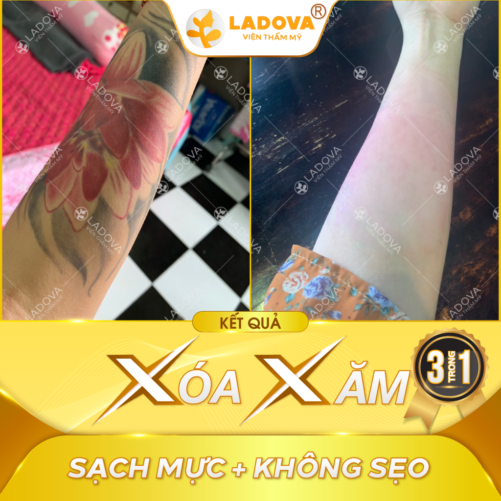 xoa-xam-mau-o-canh-tay-01